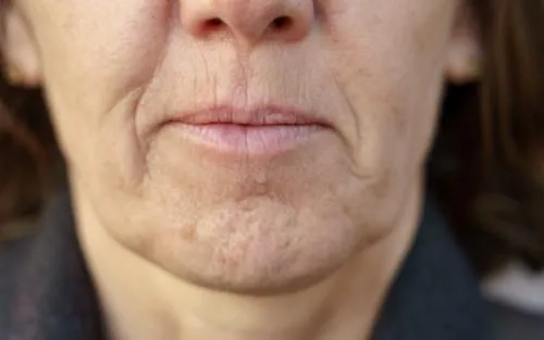 Botox for a Dimpled Chin