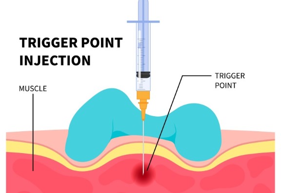 How Are the Injections Administered Into the Trapezius Muscle? How Are the Injections Administered Into the Trapezius Muscle?