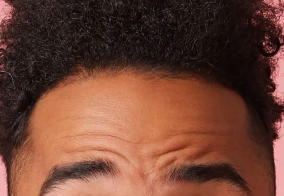 How Much Does It Cost to Treat Forehead Lines With Botox? How Much Does It Cost to Treat Forehead Lines With Botox?