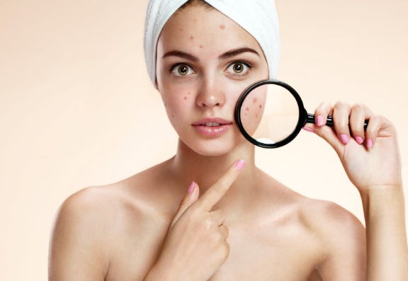 Treating Acne Treating Acne