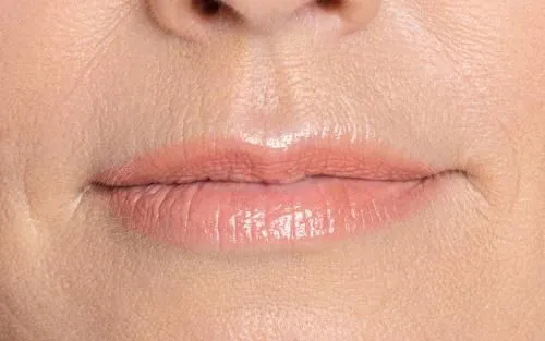 Botox for Lip Lines