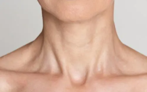 Botox for Neck Bands